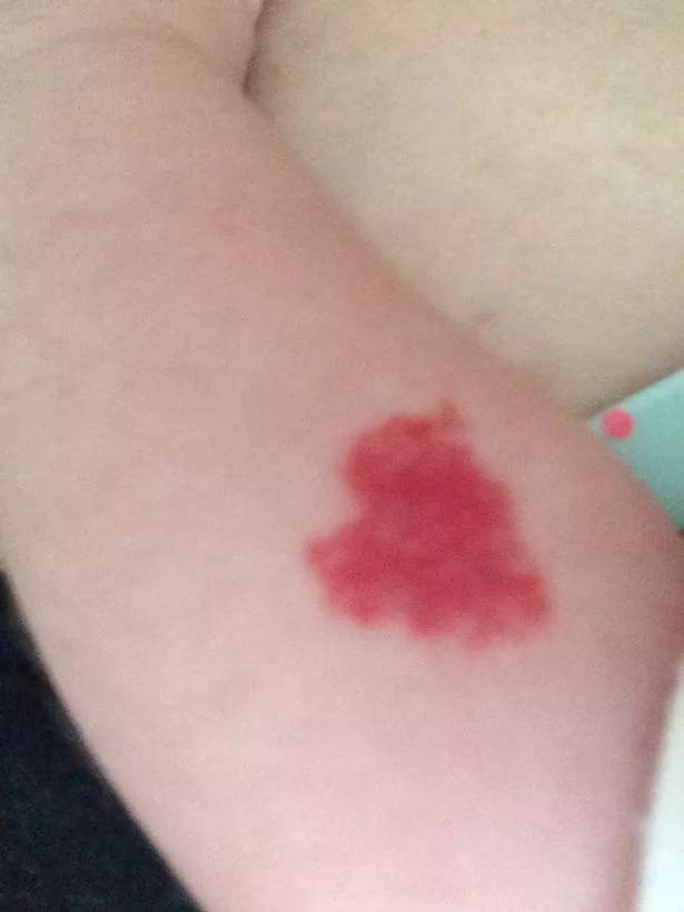 Symbolism of Heart Shaped Birthmarks